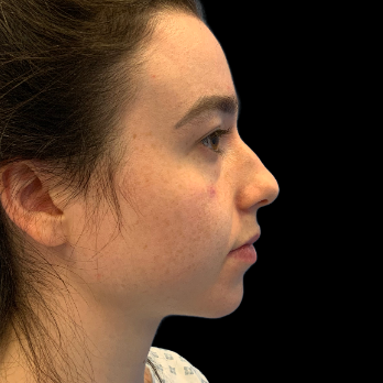 ultrasonic-rhinoplasty-before